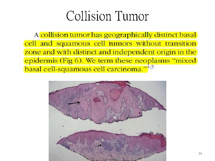 Collision Tumor 24 Collision Tumor 24