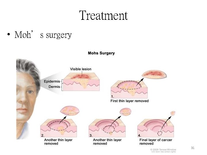 Treatment • Moh’s surgery 31 Treatment • Moh’s surgery 31