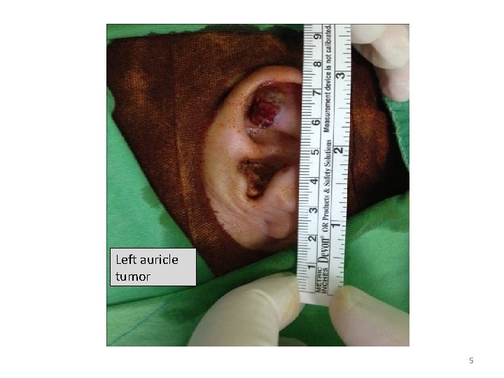 Left auricle tumor 5 Left auricle tumor 5