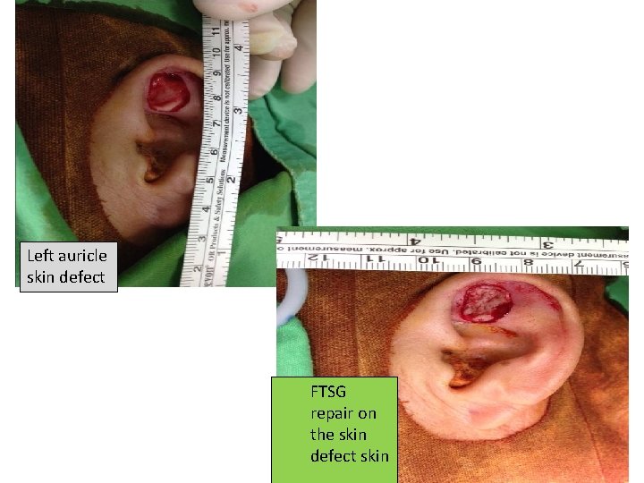 Left auricle skin defect FTSG repair on the skin defect skin 7 Left auricle skin defect FTSG repair on the skin defect skin 7