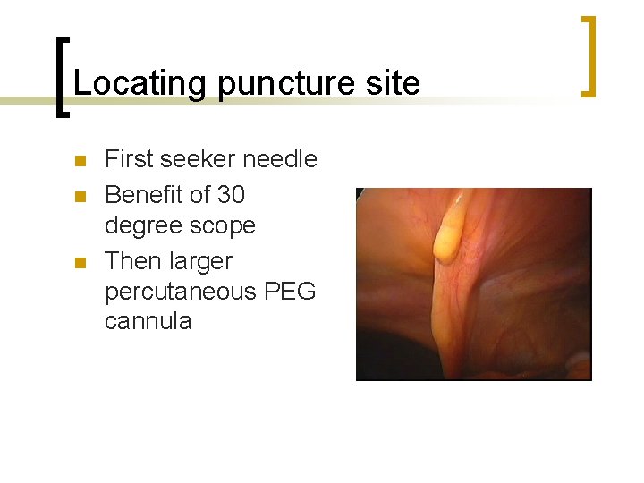Locating puncture site n n n First seeker needle Benefit of 30 degree scope