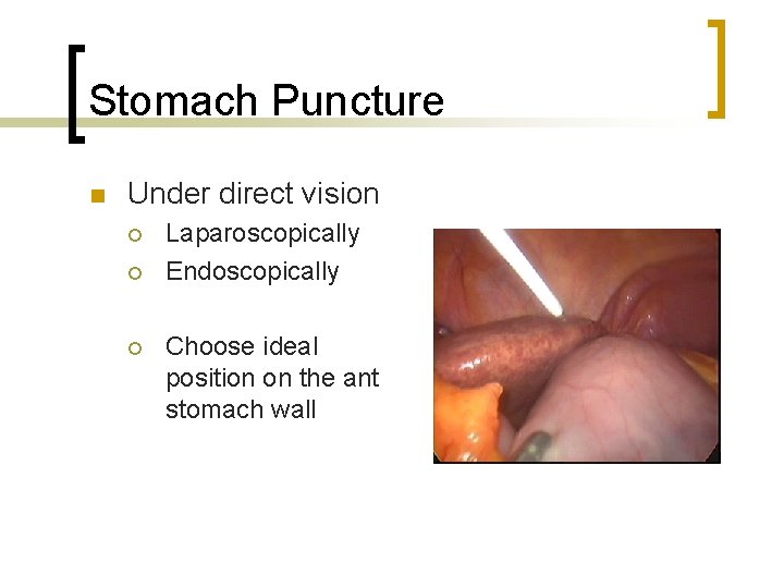 Stomach Puncture n Under direct vision ¡ ¡ ¡ Laparoscopically Endoscopically Choose ideal position
