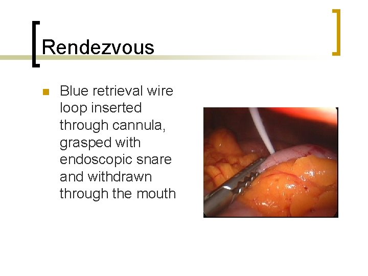 Rendezvous n Blue retrieval wire loop inserted through cannula, grasped with endoscopic snare and