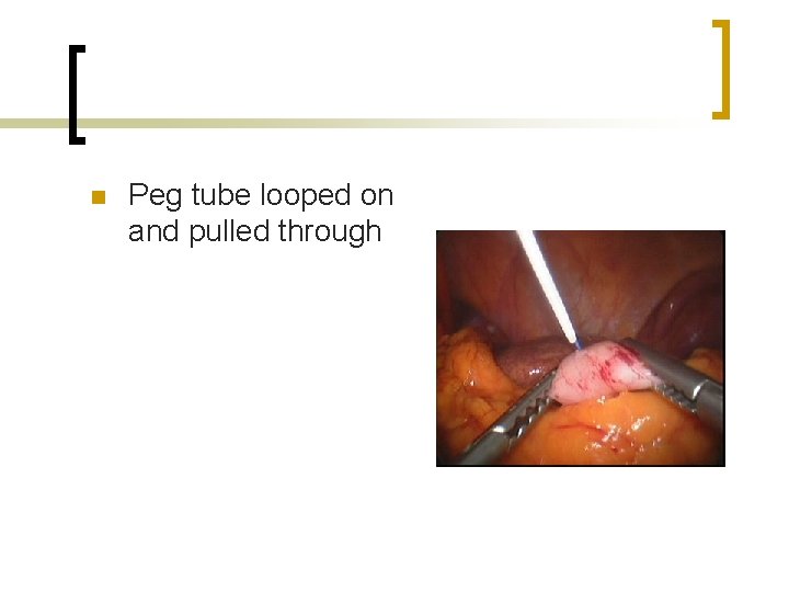 n Peg tube looped on and pulled through 