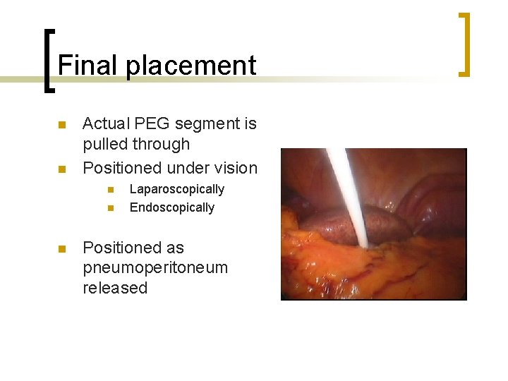 Final placement n n Actual PEG segment is pulled through Positioned under vision n