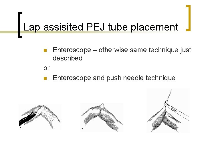 Lap assisited PEJ tube placement n Enteroscope – otherwise same technique just described or