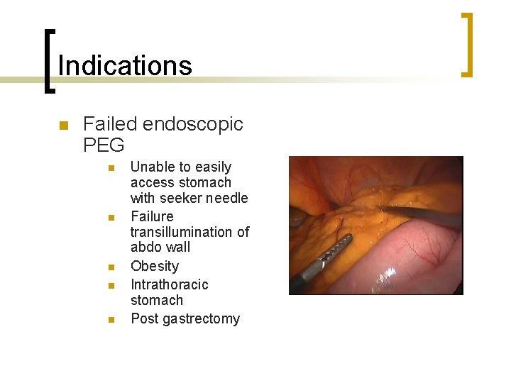 Indications n Failed endoscopic PEG n n n Unable to easily access stomach with
