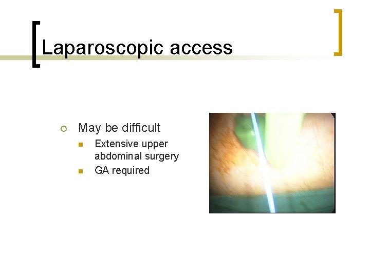 Laparoscopic access ¡ May be difficult n n Extensive upper abdominal surgery GA required