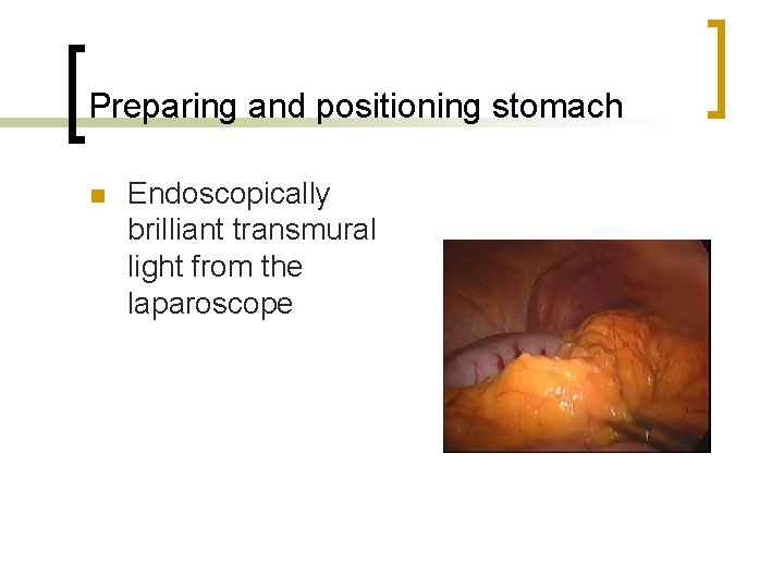 Preparing and positioning stomach n Endoscopically brilliant transmural light from the laparoscope 