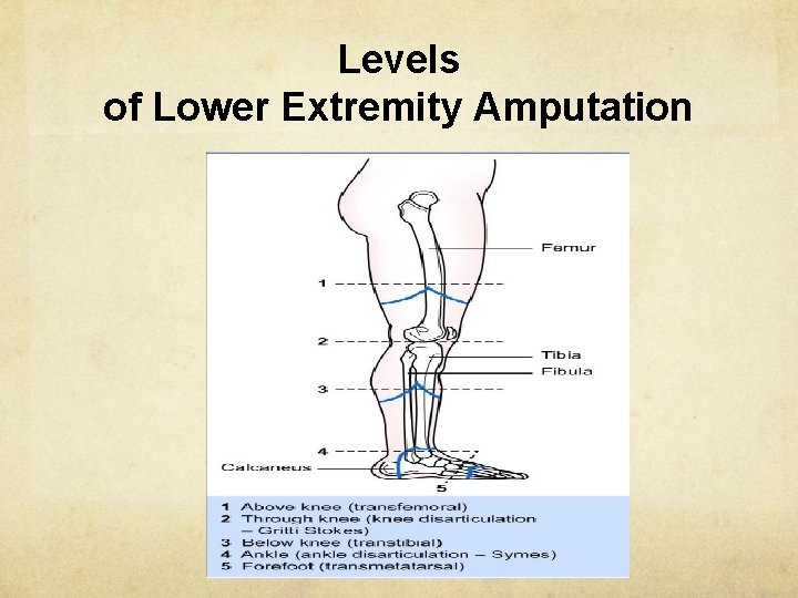Levels of Lower Extremity Amputation 