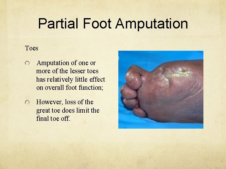 Partial Foot Amputation Toes Amputation of one or more of the lesser toes has