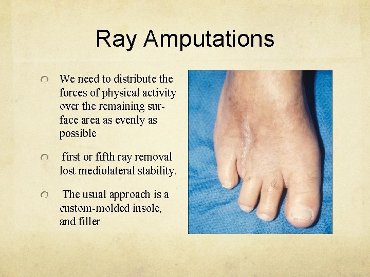 Ray Amputations We need to distribute the forces of physical activity over the remaining