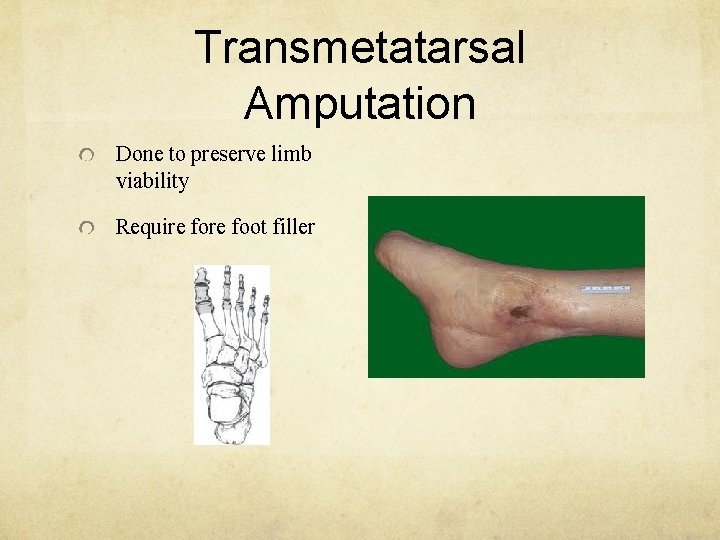 Transmetatarsal Amputation Done to preserve limb viability Require foot filler 