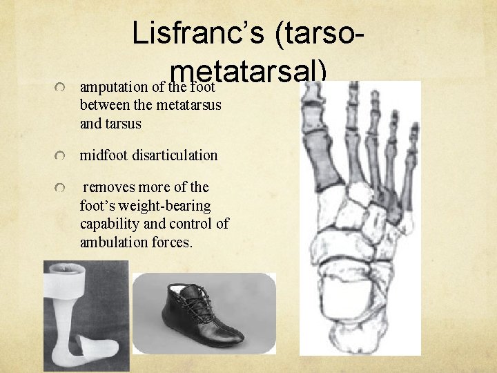 Lisfranc’s (tarsometatarsal) amputation of the foot between the metatarsus and tarsus midfoot disarticulation removes