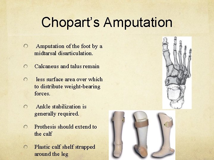 Chopart’s Amputation of the foot by a midtarsal disarticulation. Calcaneus and talus remain less