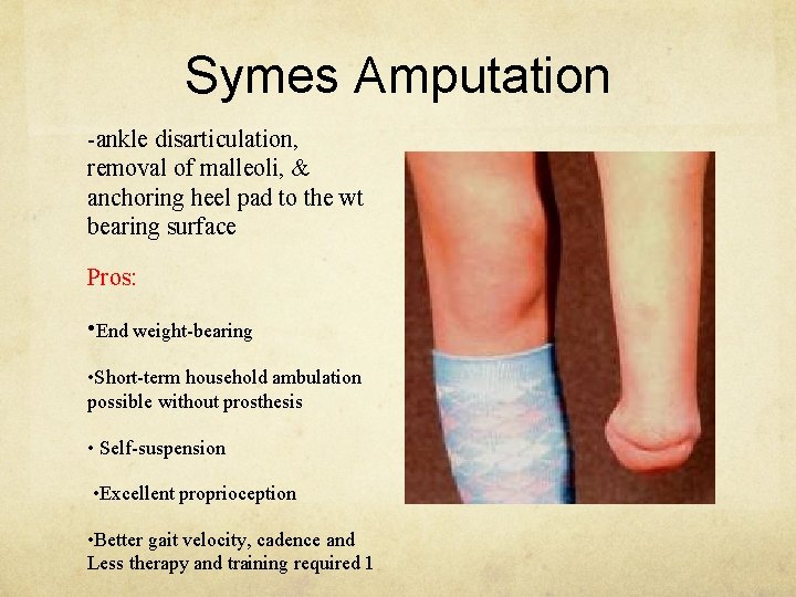 Symes Amputation -ankle disarticulation, removal of malleoli, & anchoring heel pad to the wt