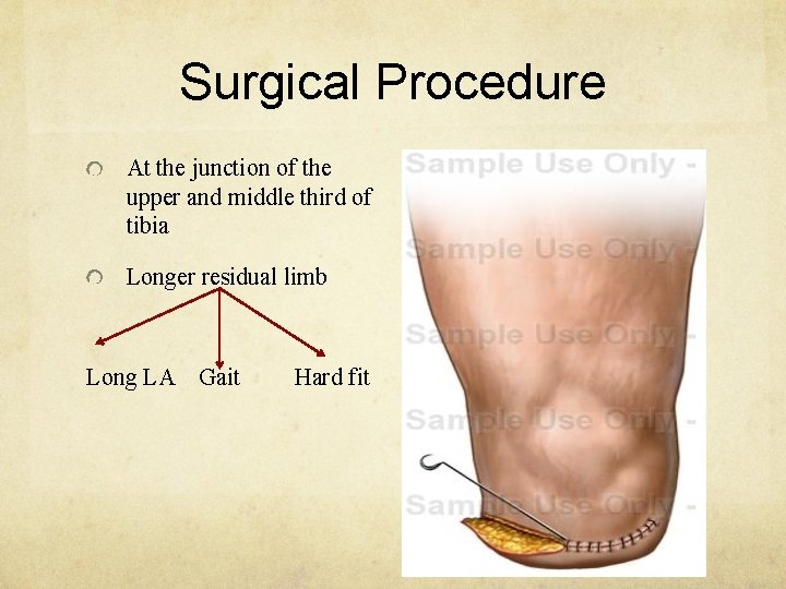 Surgical Procedure At the junction of the upper and middle third of tibia Longer
