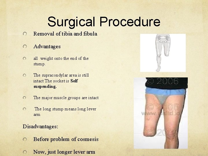 Surgical Procedure Removal of tibia and fibula Advantages all weight onto the end of