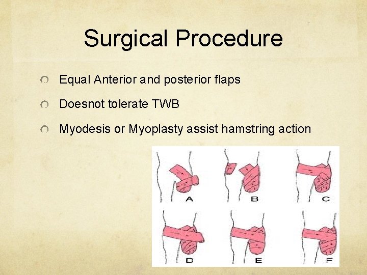 Surgical Procedure Equal Anterior and posterior flaps Doesnot tolerate TWB Myodesis or Myoplasty assist