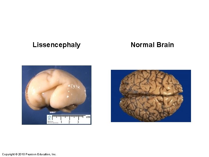 Lissencephaly Copyright © 2010 Pearson Education, Inc. Normal Brain 