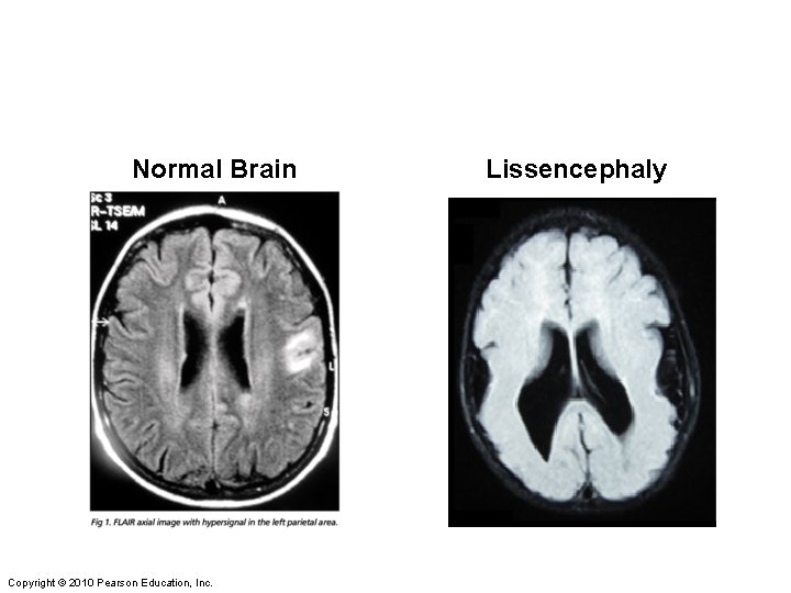 Normal Brain Copyright © 2010 Pearson Education, Inc. Lissencephaly 
