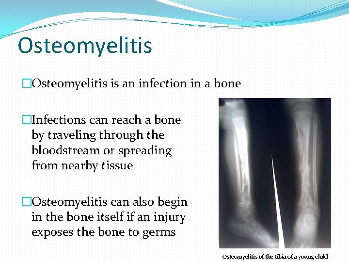 Osteomyelitis �Osteomyelitis is an infection in a bone �Infections can reach a bone by