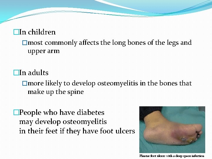 �In children �most commonly affects the long bones of the legs and upper arm