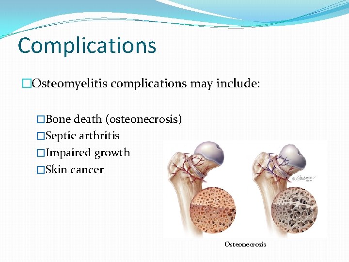 Complications �Osteomyelitis complications may include: �Bone death (osteonecrosis) �Septic arthritis �Impaired growth �Skin cancer