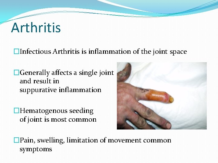 Arthritis �Infectious Arthritis is inflammation of the joint space �Generally affects a single joint