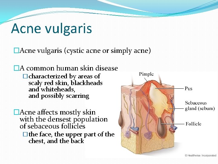 Acne vulgaris �Acne vulgaris (cystic acne or simply acne) �A common human skin disease