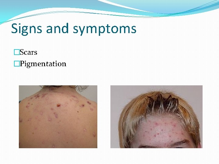 Signs and symptoms �Scars �Pigmentation 