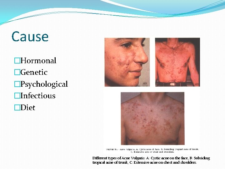 Cause �Hormonal �Genetic �Psychological �Infectious �Diet Different types of Acne Vulgaris: A: Cystic acne