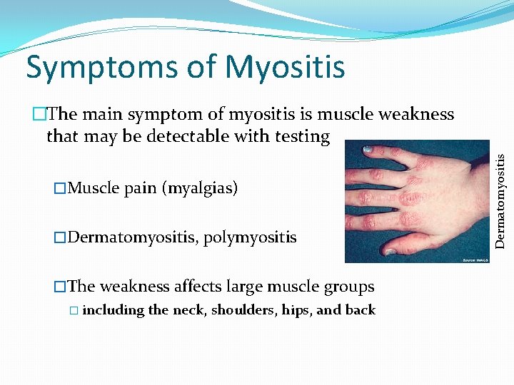 Symptoms of Myositis �Muscle pain (myalgias) �Dermatomyositis, polymyositis �The weakness affects large muscle groups