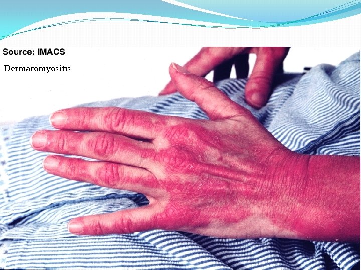 Dermatomyositis 