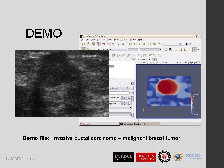DEMO Demo file: Invasive ductal carcinoma – malignant breast tumor 17 March 2015 