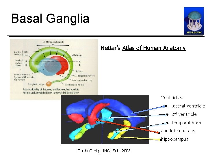 Basal Ganglia Netter’s Atlas of Human Anatomy Ventricles: lateral ventricle 3 rd ventricle temporal