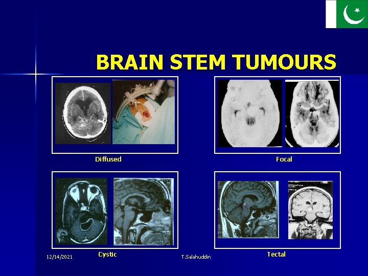 BRAIN STEM TUMOURS Diffused 12/14/2021 Cystic Focal T. Salahuddin Tectal 