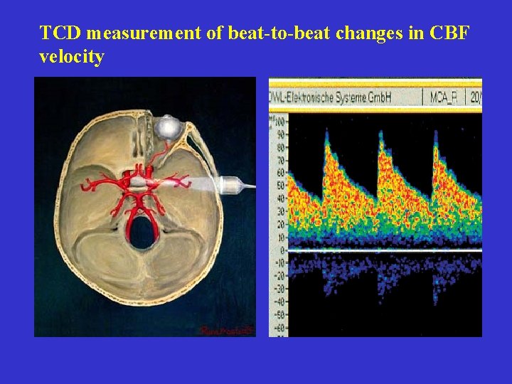 TCD measurement of beat-to-beat changes in CBF velocity 