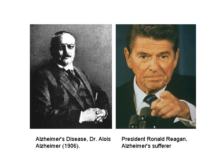 Alzheimer's Disease, Dr. Alois Alzheimer (1906). President Ronald Reagan, Alzheimer's sufferer 