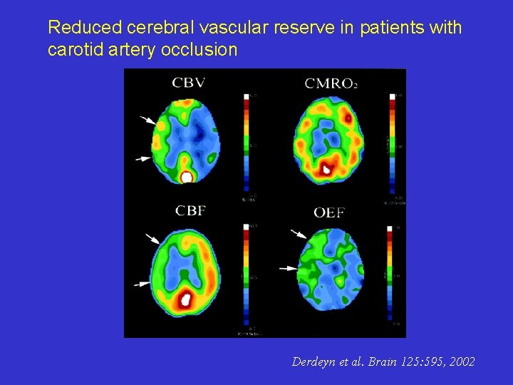 Reduced cerebral vascular reserve in patients with carotid artery occlusion Derdeyn et al. Brain