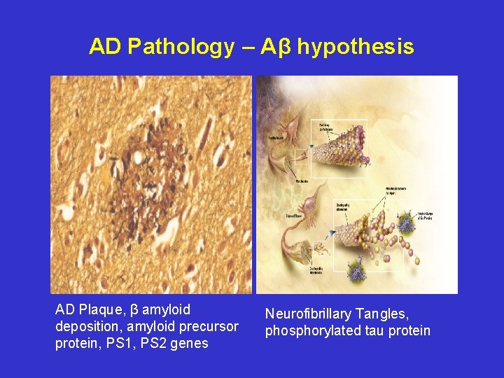 AD Pathology – Aβ hypothesis AD Plaque, β amyloid deposition, amyloid precursor protein, PS