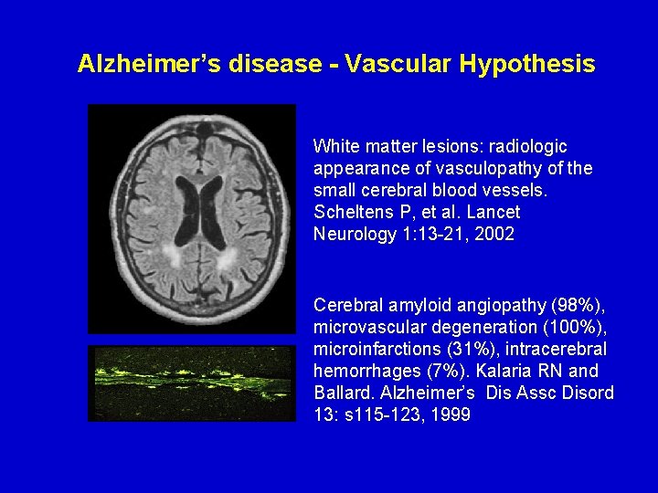 Alzheimer’s disease - Vascular Hypothesis White matter lesions: radiologic appearance of vasculopathy of the
