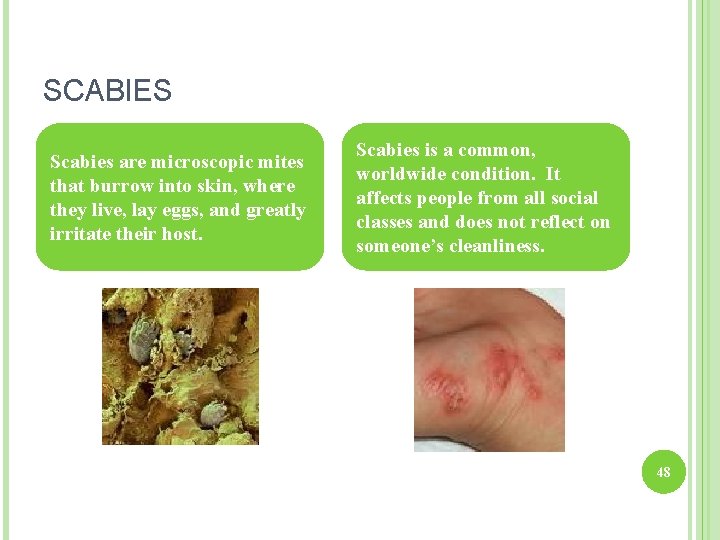 SCABIES Scabies are microscopic mites that burrow into skin, where they live, lay eggs,