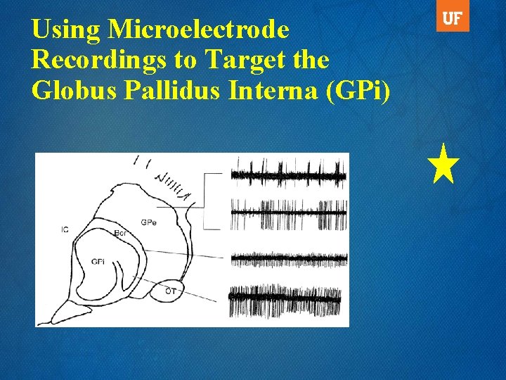 Using Microelectrode Recordings to Target the Globus Pallidus Interna (GPi) 