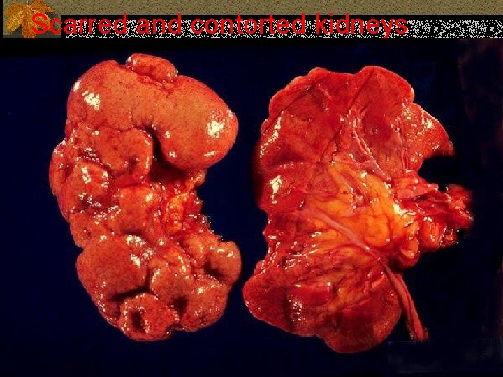 Scarred and contorted kidneys 11 