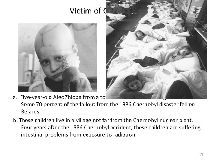 Victim of Chernobyl a. Five-year-old Alec Zhloba from a town in Belarus is suffering
