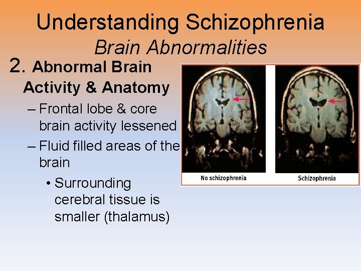 Understanding Schizophrenia Brain Abnormalities 2. Abnormal Brain Activity & Anatomy – Frontal lobe &