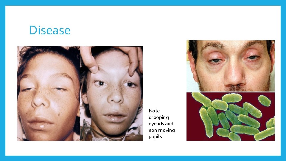 Disease Note drooping eyelids and non moving pupils 