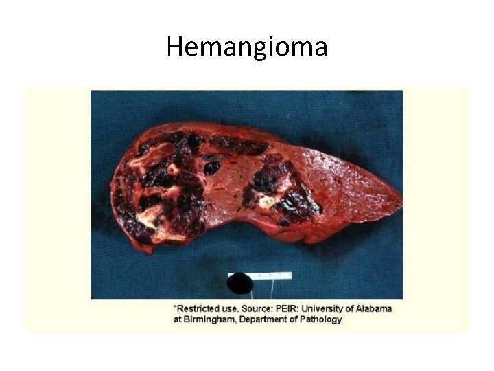 Hemangioma 