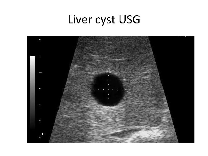 Liver cyst USG 
